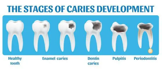 tooth-decay-2