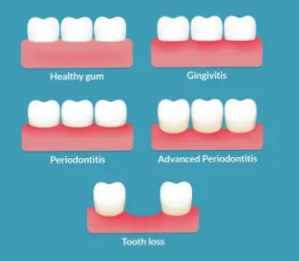 Stages of Gum Diseases - House of Smiles