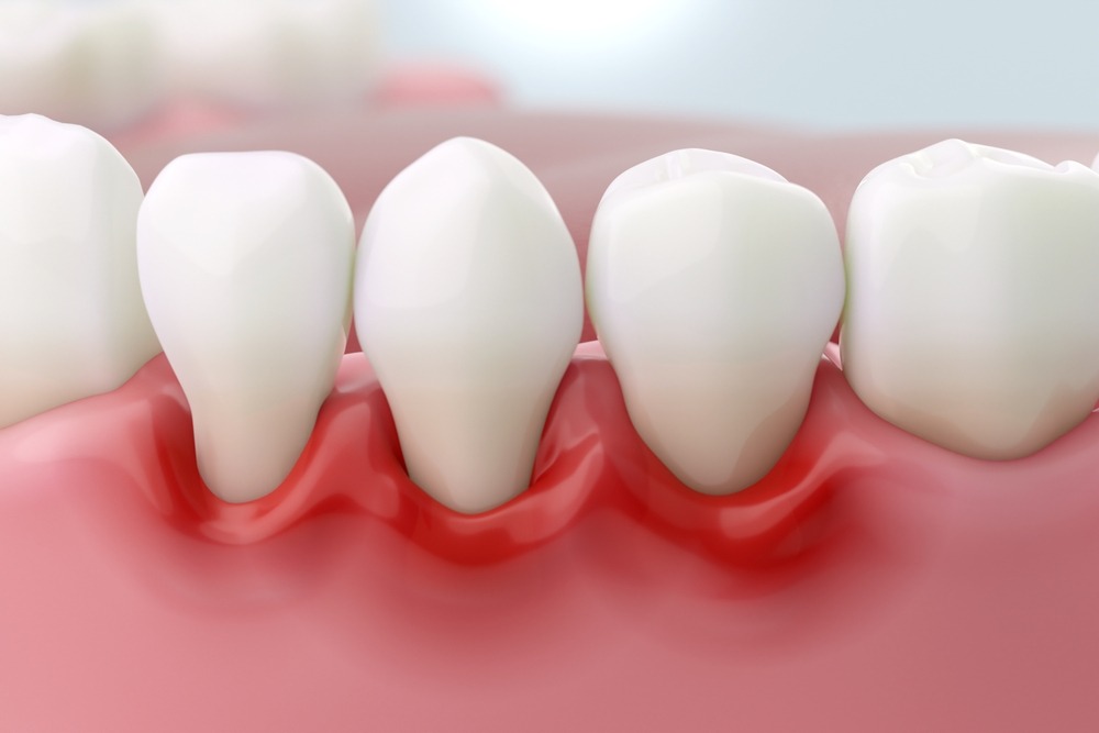 Stages of Gum Diseases