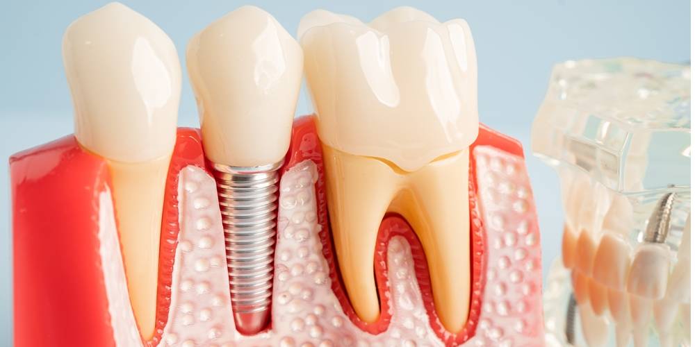 Dental Implant