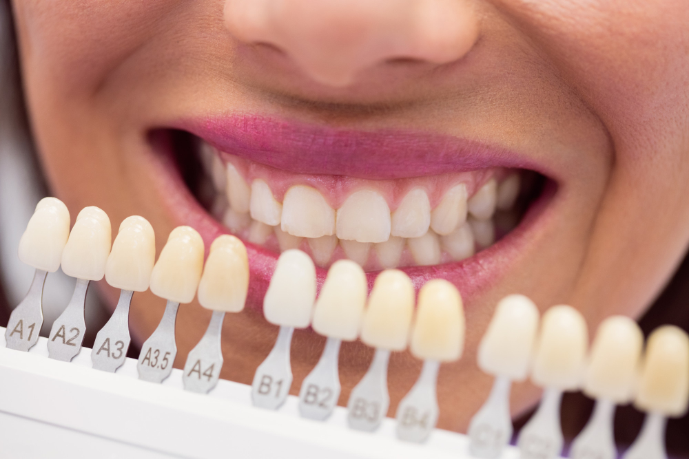 Know More About Dental Veneers