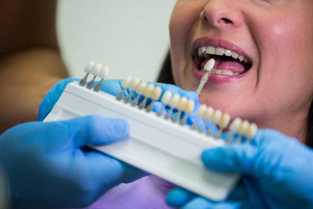 How Veneers Enhance Facial Aesthetics Beyond Just Teeth