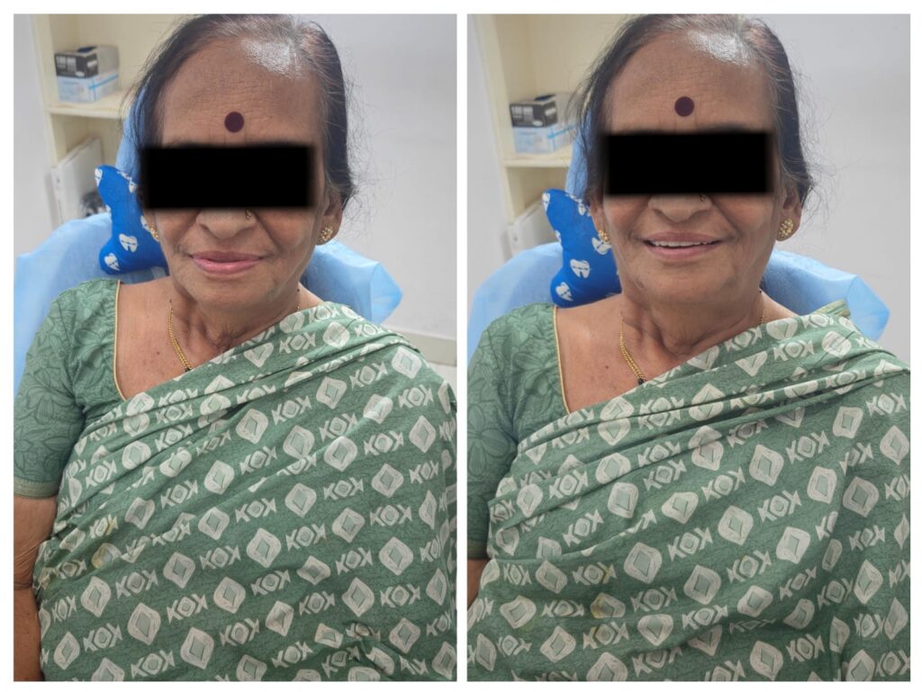 Removable dentures