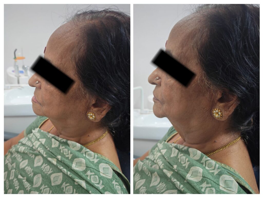 Removable Complete and Partial Dentures