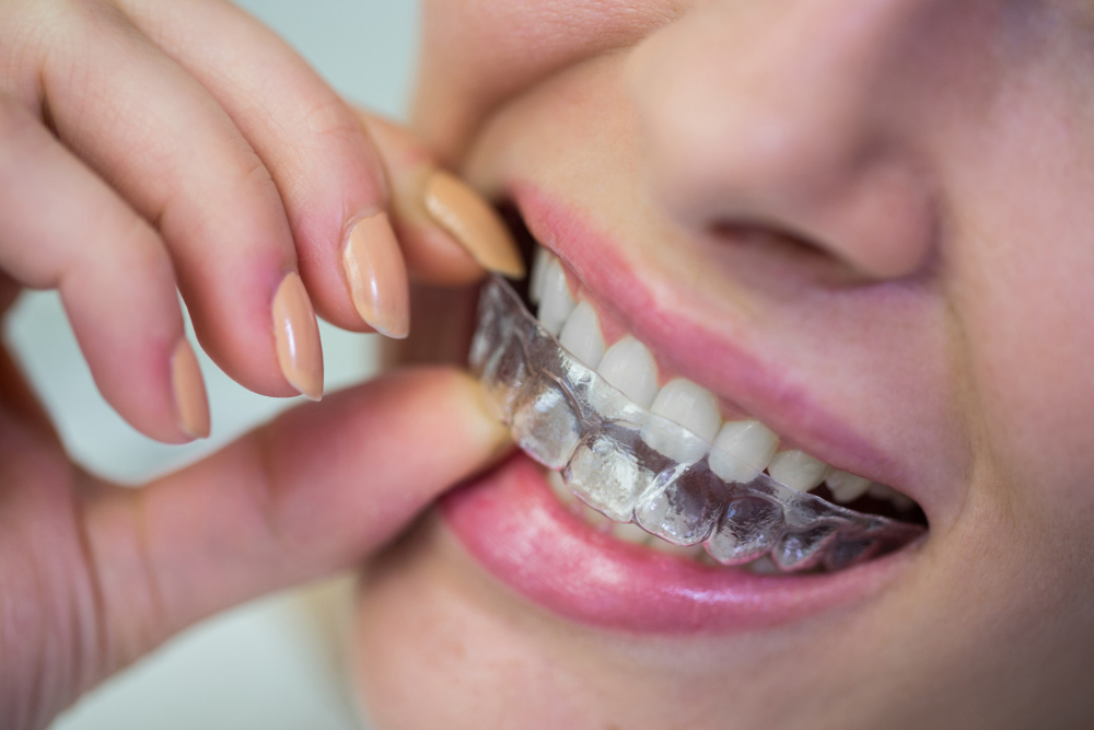Clear Aligners vs Traditional Braces: Which Is Better?