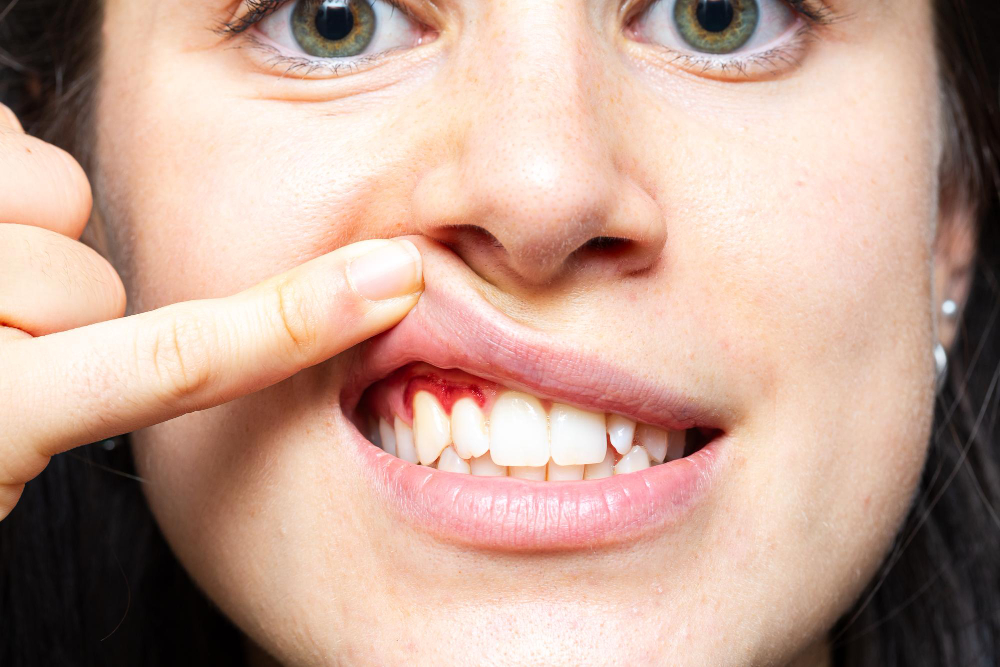 Bleeding Gums Diagnosis Guide: When Laser Therapy Becomes Necessary