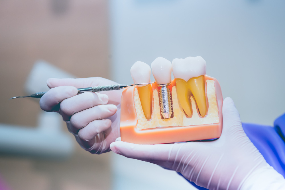 Single vs. Multiple Implants vs. All-on-X: Comparing Restoration Strategies for Different Tooth Loss Scenarios