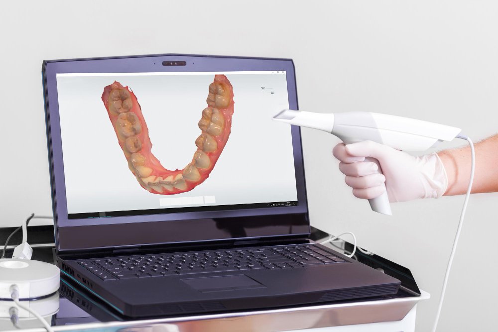 How Intraoral Scanners Are Changing the Dental Experience