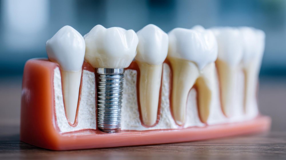 Single Dental Implant vs. Dental Bridge: Which Option Is Right for You?